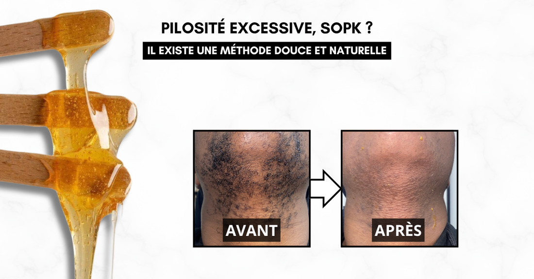 SOPK et pilosité : pourquoi la cire orientale peut faire la différence