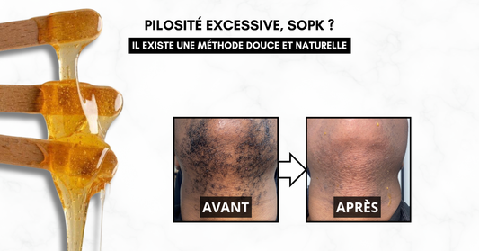 SOPK et pilosité : pourquoi la cire orientale peut faire la différence